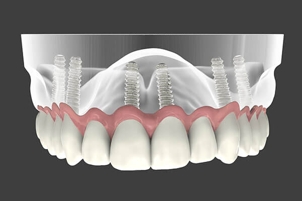 Dental Implant Supported Dentures in Albuquerque