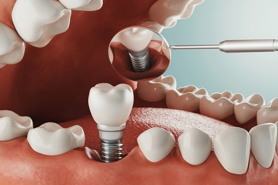 A Patient's Guide to The Dental Implant Procedure