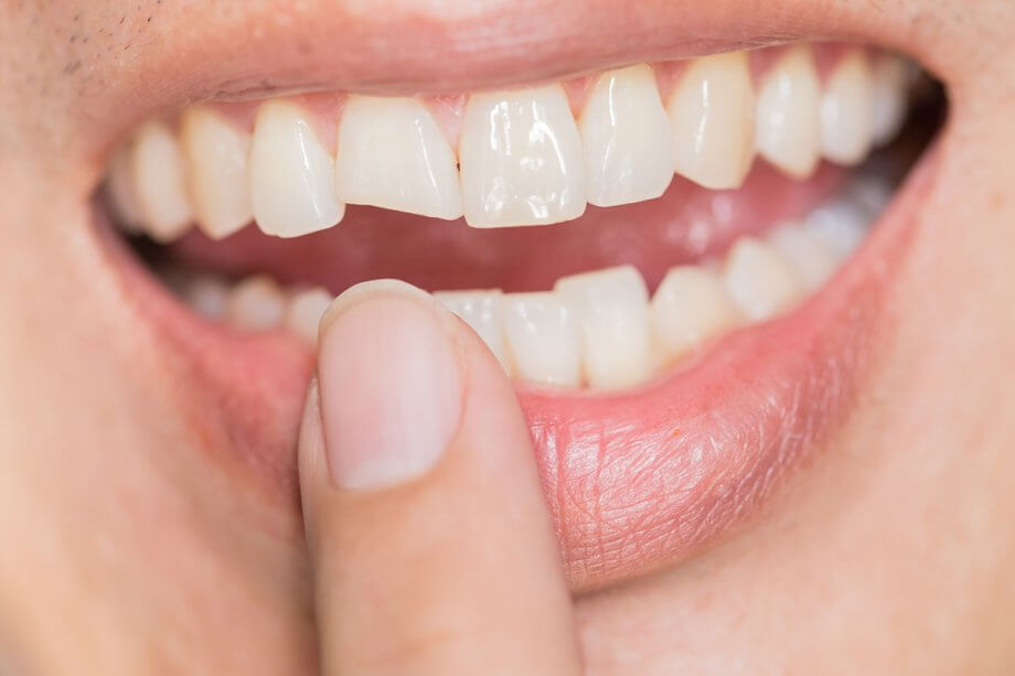 Can a Broken Tooth Be Saved? Options After Dental Trauma