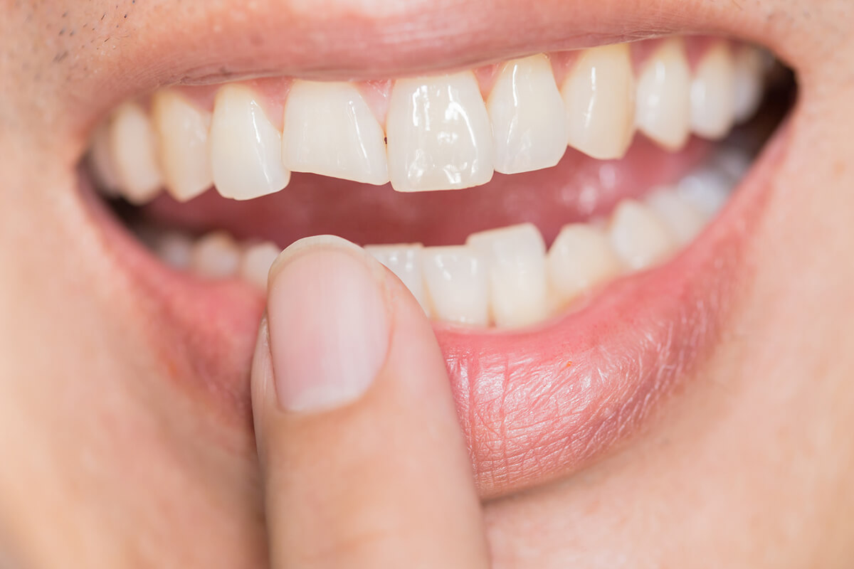 Can a Broken Tooth Be Saved? Options After Dental Trauma