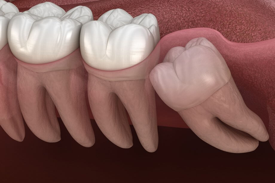 Can I Keep My Wisdom Teeth If They Don’t Hurt?