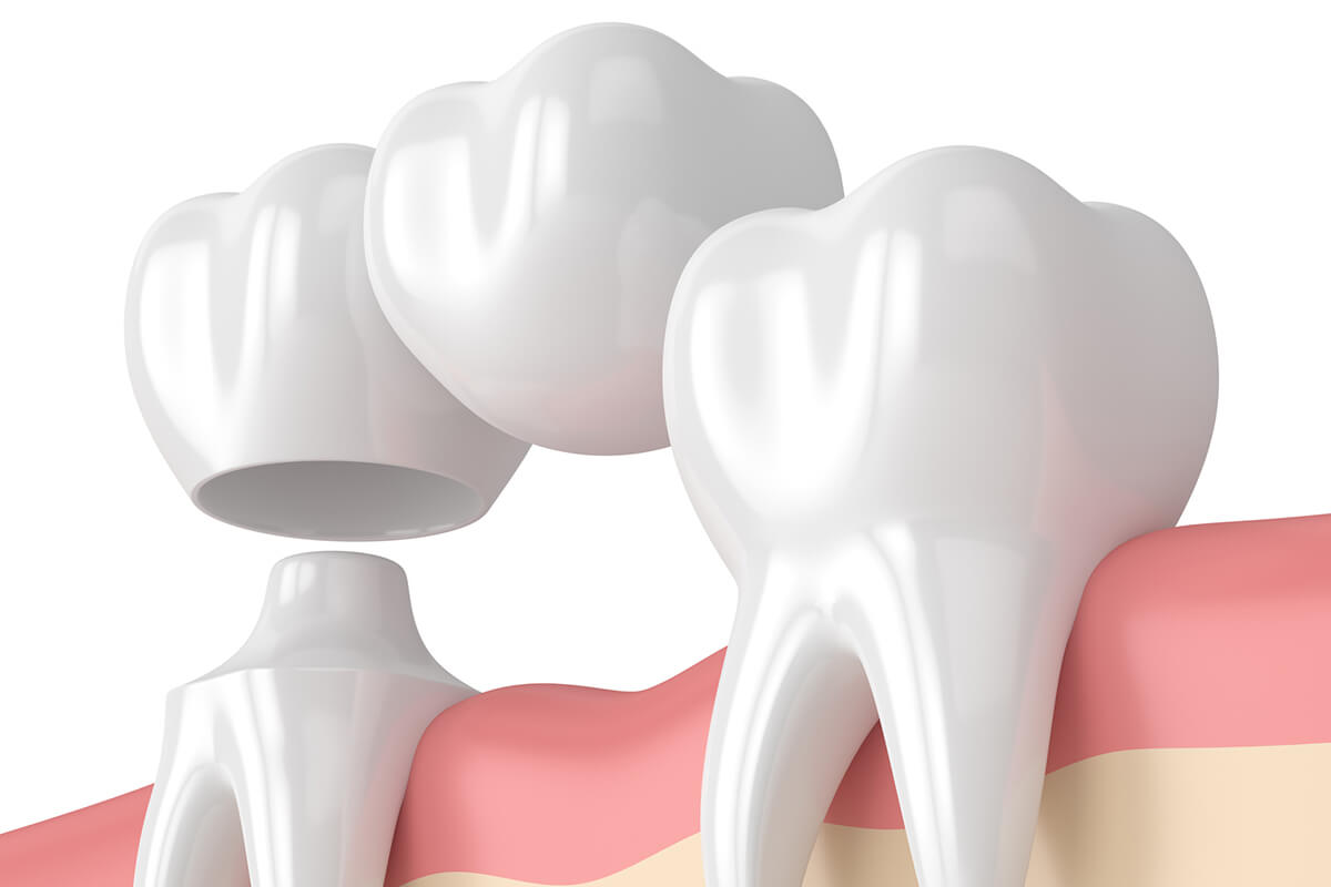 Dental Bridge vs Implant: Which is Better?