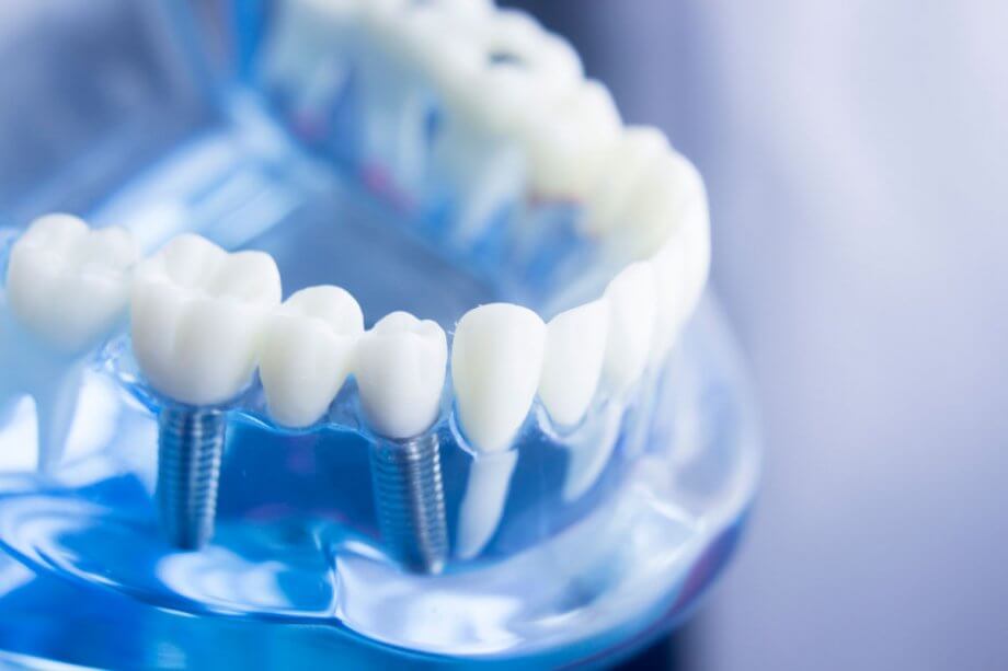 clear model of dental implants