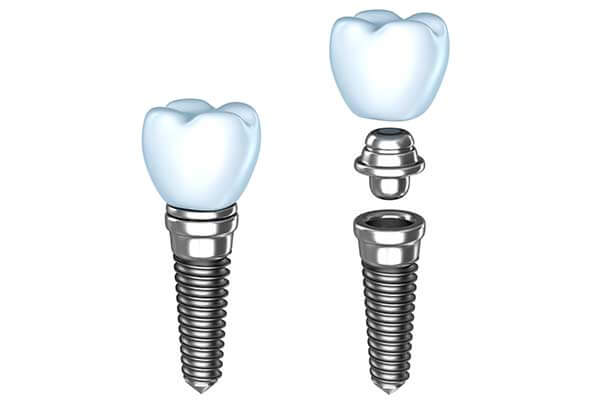 Single Dental Implants in Albuquerque