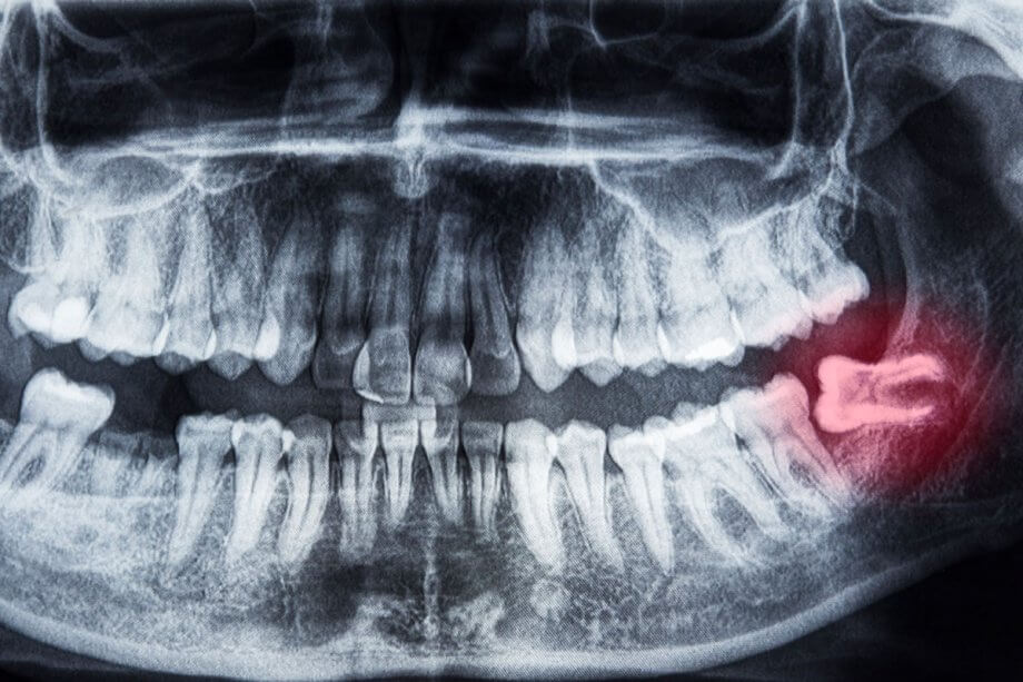 dental x-ray of wisdom tooth