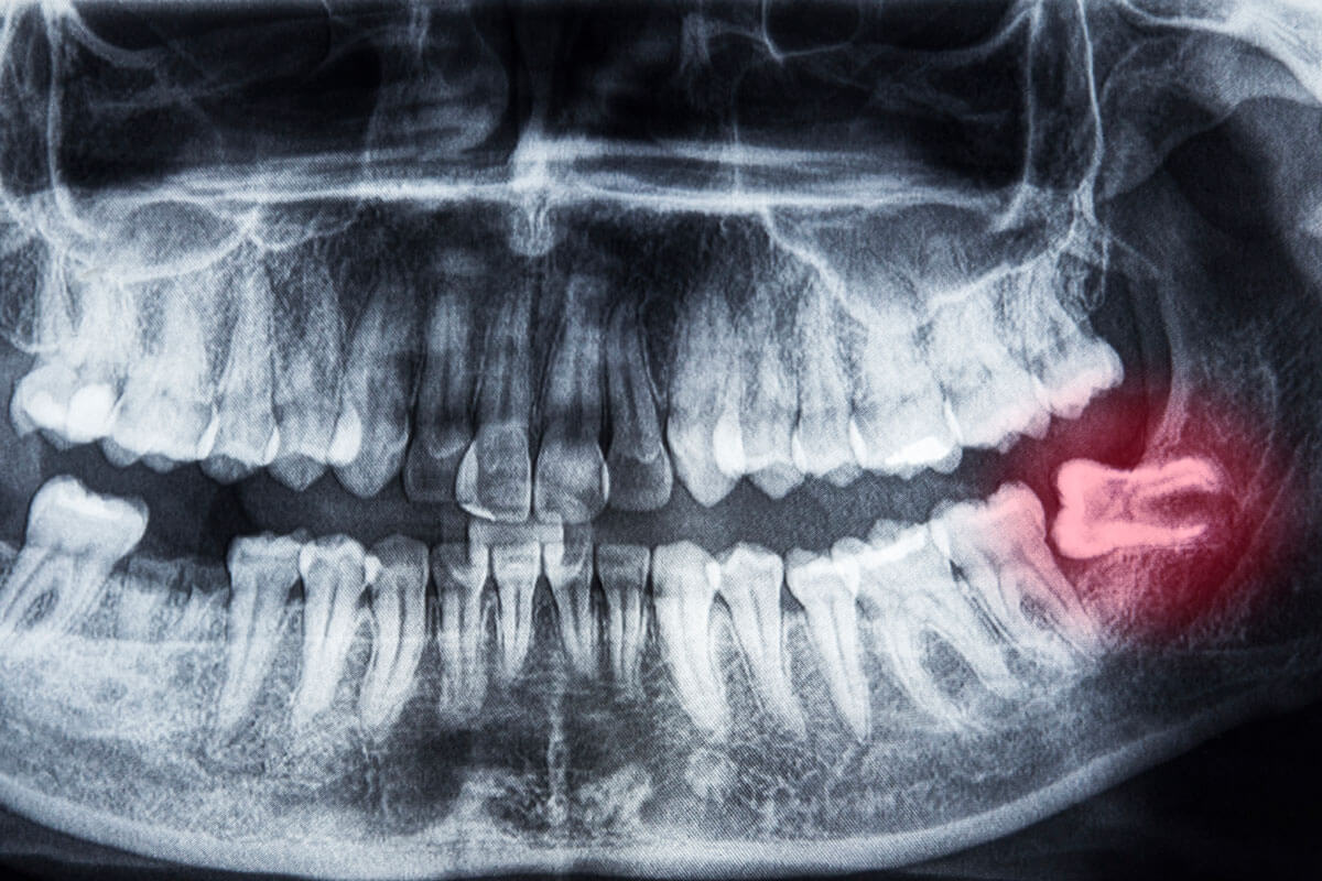 dental x-ray of wisdom tooth