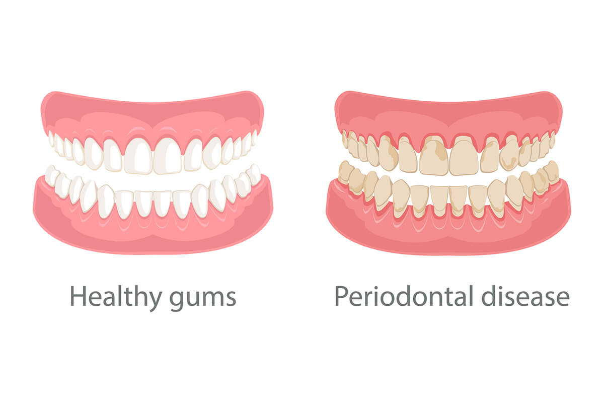 How Does a Periodontist Fix Receding Gums?