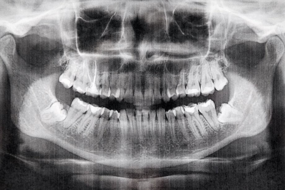 How Long Does It Take Wisdom Teeth To Heal?