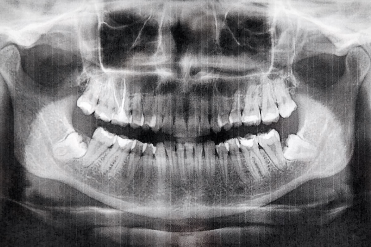 How Long Does It Take Wisdom Teeth To Heal?