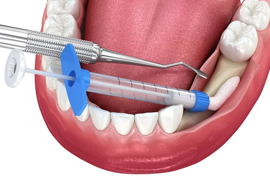 How Much Does Bone Grafting Cost in Albuquerque, NM?