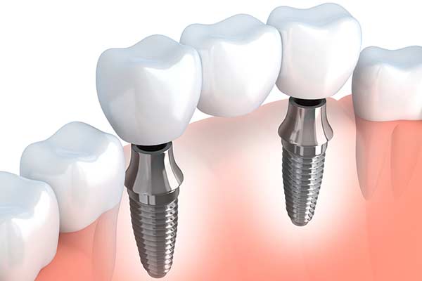 Dental Implant Supported Bridges in Albuquerque