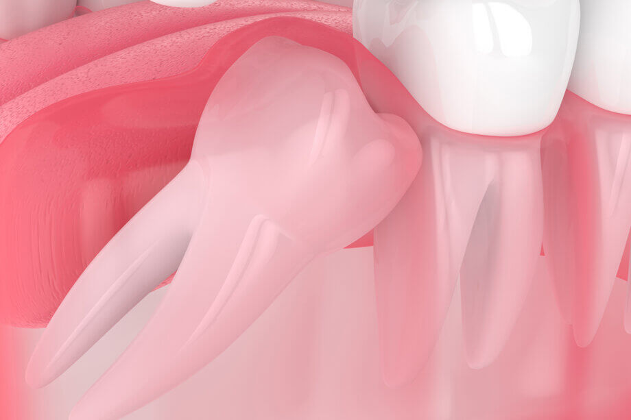 Warning Signs of Wisdom Tooth Infection