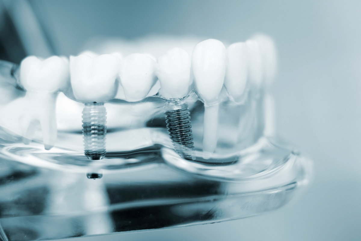 What is a Full Arch Dental Implant?