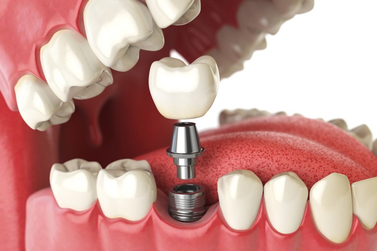 What’s the cost of a dental implant for one tooth? ABQ