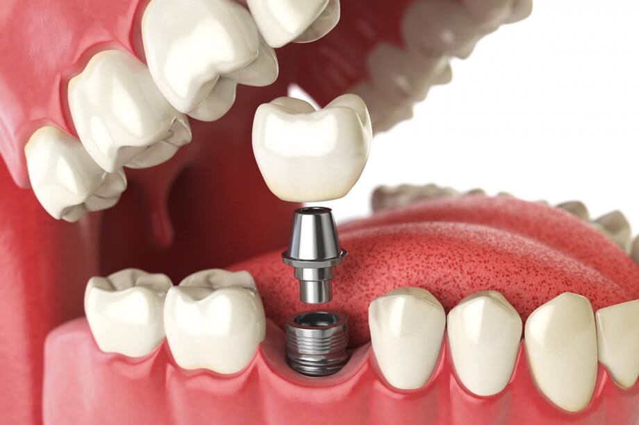 What’s the cost of a dental implant for one tooth?
