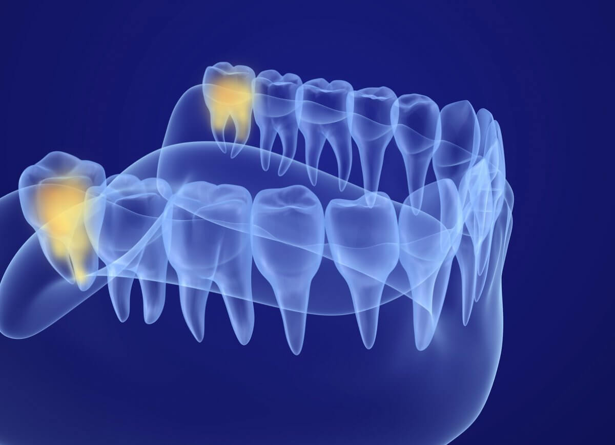 XRay View Of Wisdom Teeth