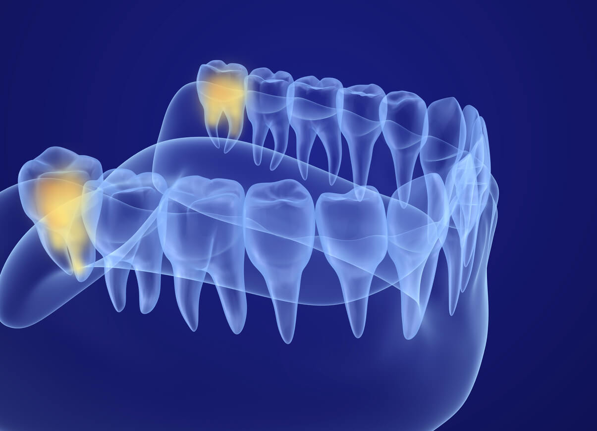 Top Wisdom Teeth Questions & Answers Rio Grande Oral Surgery